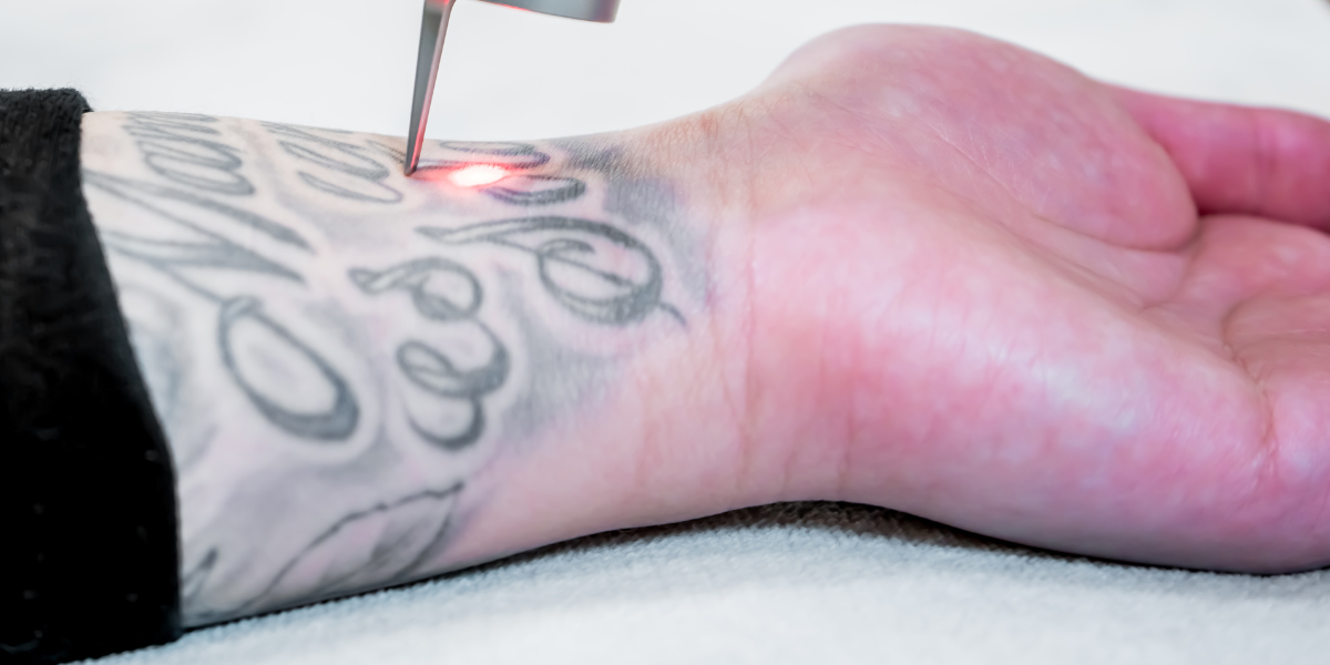 Laser Tattoo Removal - Benefits, Costs, Results & Procedure Steps