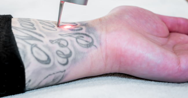 Tattoo removal STAC Tattoo removal STAC